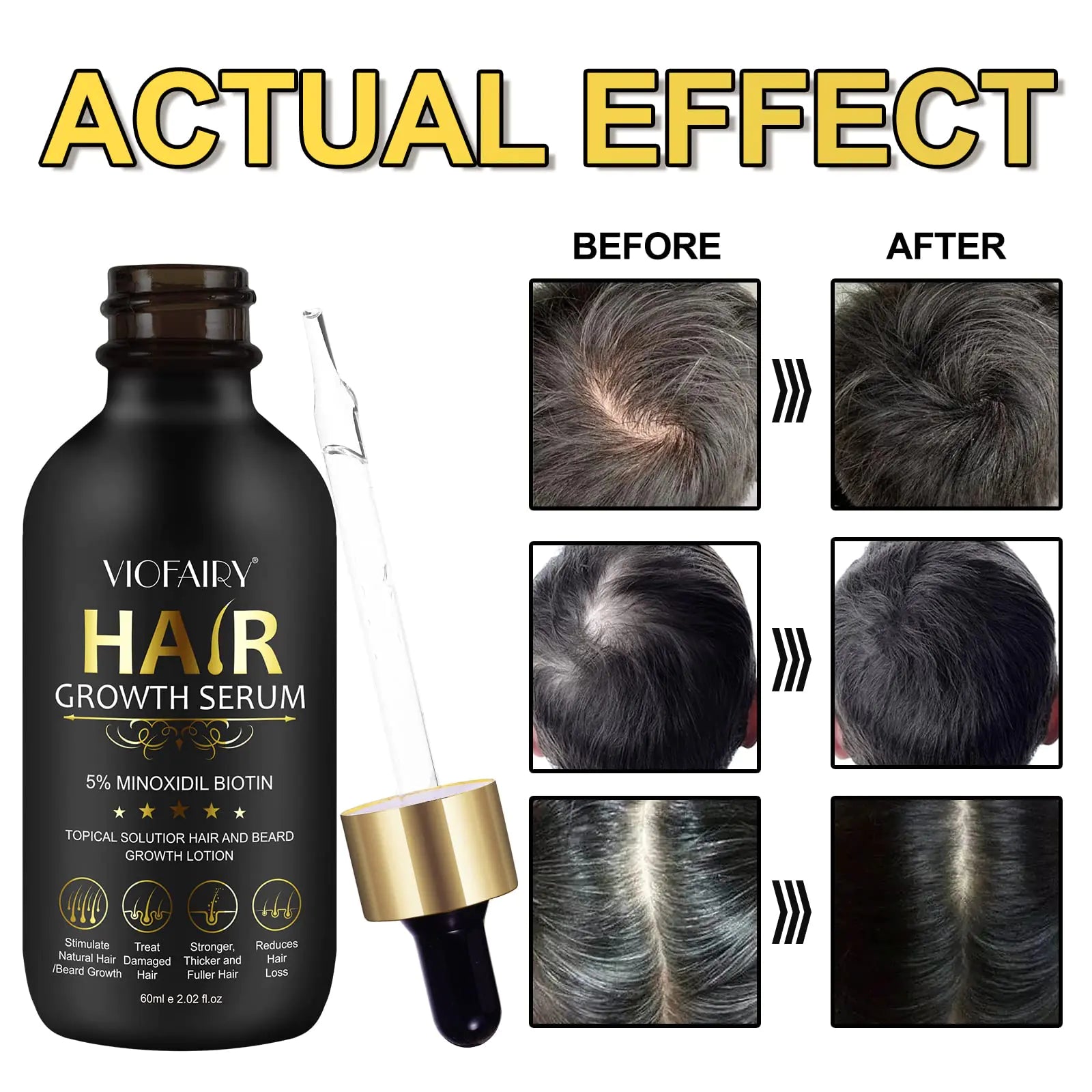 "Viofairy Hair Growth Serum with Minoxidil, shows before and after results for hair regrowth, 2.02 oz"